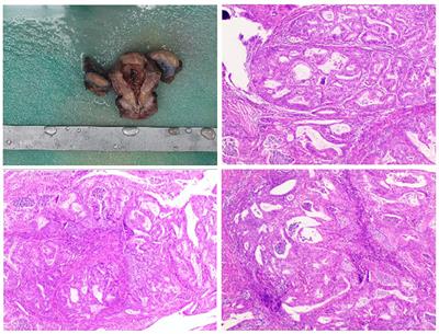 Enhanced acupuncture therapy for radiotherapy-related neuropathic pain in patients with gynecologic cancer: a report of two cases and brief review